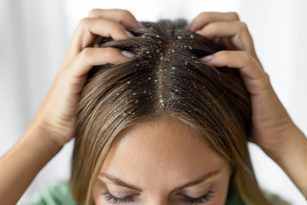 Astrological Remedies to Prevent Hair fall Dandruff and Skin Problems